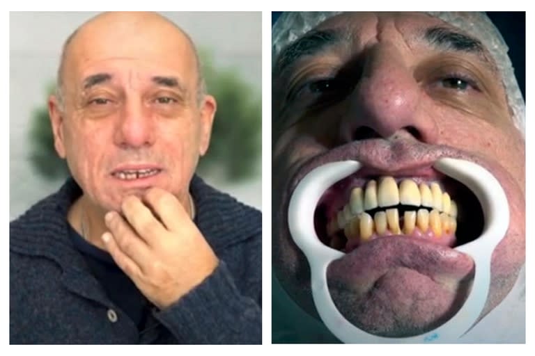 Toti Ciliberto debió pasar por el quirófano a raíz de una periodontitis avanzada, una enfermedad bucal hereditaria que lo aquejó durante años