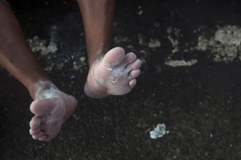 FILE - In this Oct. 21, 2018 file photo, a Honduran migrant's blistered feet are covered in talcum powder during a stop in Tecun Uman, Guatemala. Migrants are hobbling through pain, determined to reach the U.S., while those who can no longer take it bow out of the caravan. (AP Photo/Oliver de Ros, File)