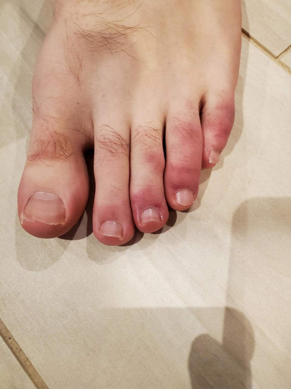 Dr. Tracey Vlahovic had a 30-year-old asymptomatic male patient with what appeared to be COVID toes because there's 
