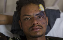 <p>Indian Dalit man Sachin kumar, 21, who was attacked by a group of people while returning from a rally, recovers at a government hospital in Meerut, about 65 kilometers from New Delhi, India, May 24, 2017. (Photo: Manish Swarup/AP) </p>