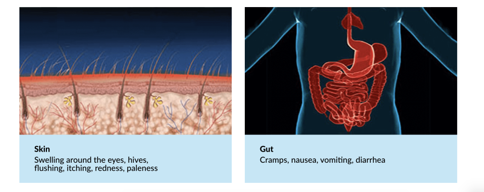 An illustration on the left showing symptoms on the skin and an illustration on the right showing symptoms, including cramps, in the gut