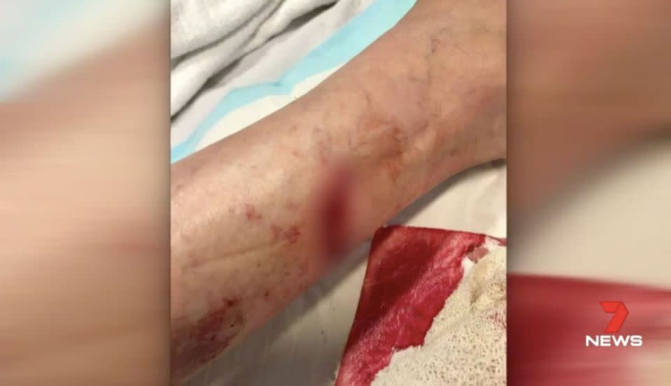 The 55-year-old required plastic surgery for a deep wound. Source: 7 News