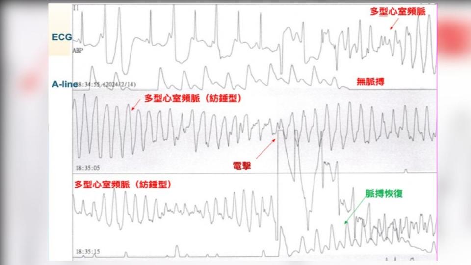 小涵電擊22次搶命，狀況才穩定下來。（圖／中國醫提供）