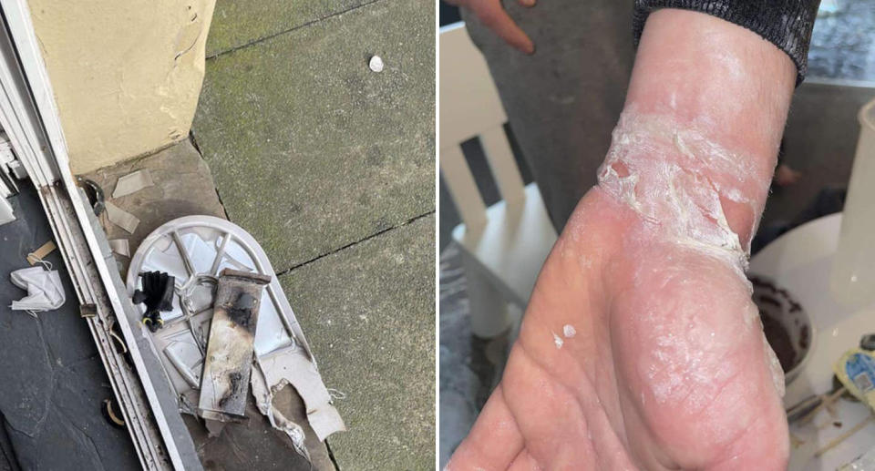 burned items from a house and a man with a burned arm after a wax burner 'exploded' in the house