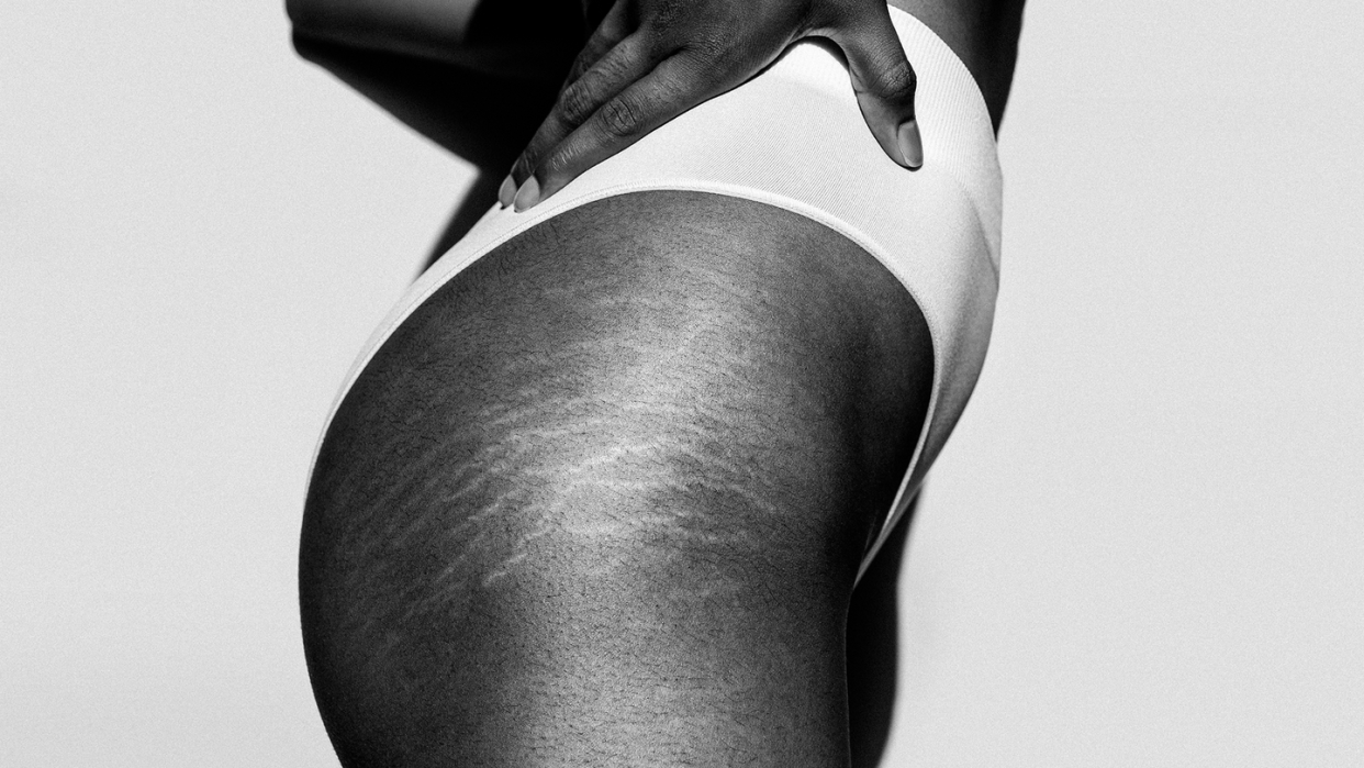 black and white picture of the stretch marks in the upper thigh of an anonymous black woman in white lingerie