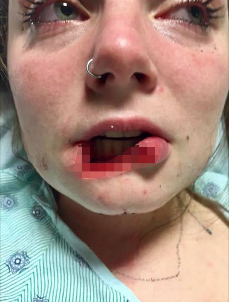 Woman Whose Ex Bit Off Her Lip Speaks Out