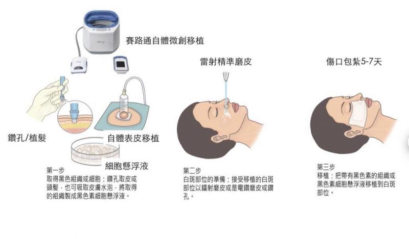 皮膚色素移植、免疫治療與光照　白斑症治療缺一不可