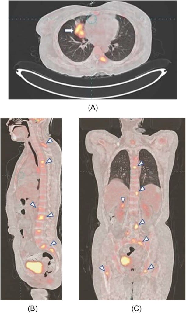 The cancer patient was not publicly identified. Singh et al/ScienceDeirect