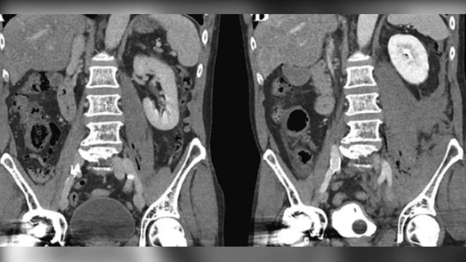 電腦斷層掃描驚見老翁的左髂腰肌周圍積聚了大量液體和氣體。（圖／翻攝自《每日郵報》）