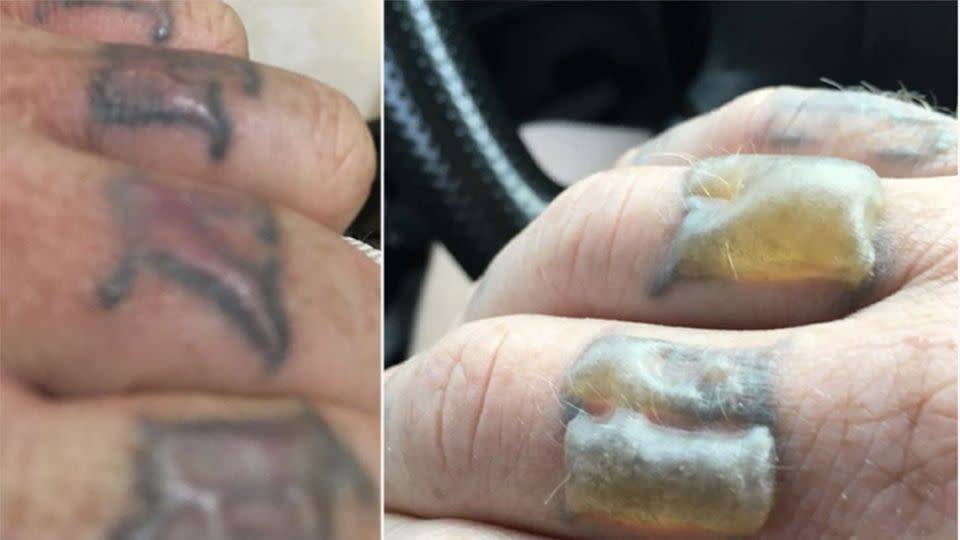 Before and after - Cameron Maltby has waned about tattoo removal after he was left with blistered hands. Photo: Cameron Maltby