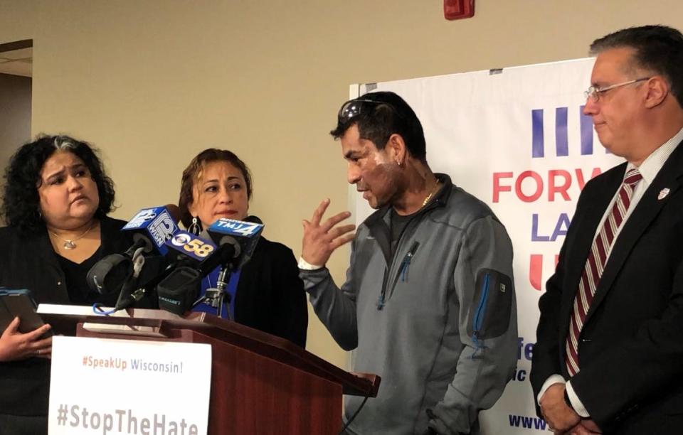 Mahud Villalaz gestures to the second-degree burns on his face at a 2019 news conference one day after a man threw acid at him outside a restaurant on Milwaukee's south side.