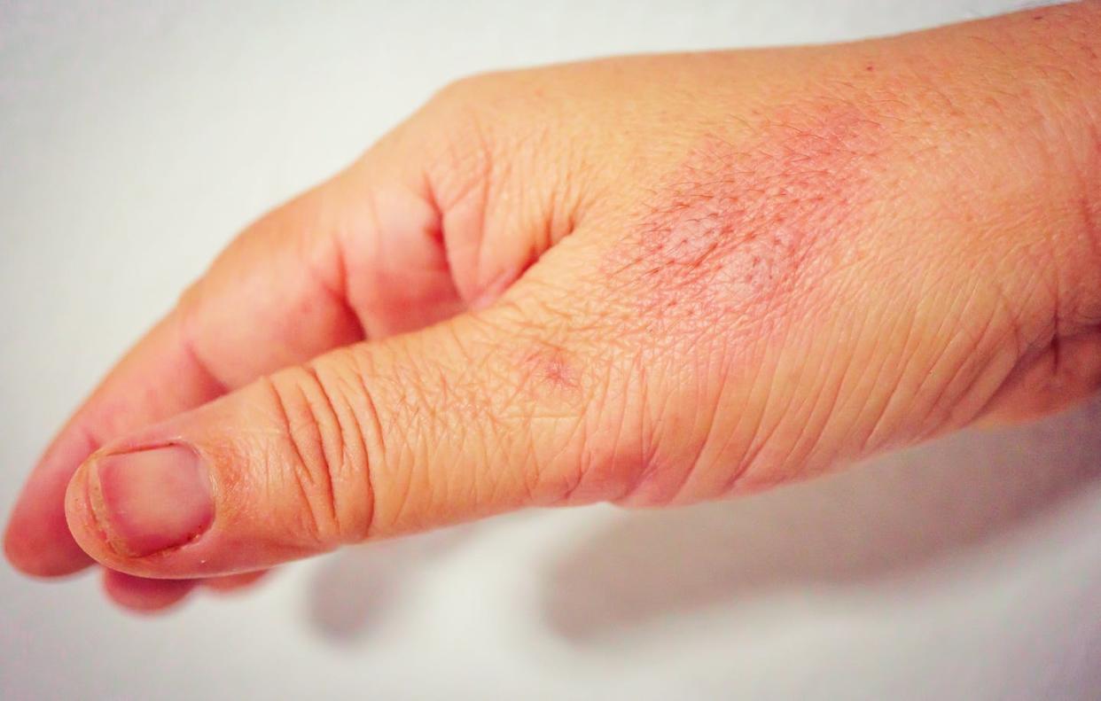 Insect bites or stings, like the one on this person's hand, are a manifestation of inflammation. <a href="https://www.gettyimages.com/detail/photo/cropped-hand-with-mosquito-bite-against-white-royalty-free-image/1187314357?phrase=insect%20bite&adppopup=true" rel="nofollow noopener" target="_blank" data-ylk="slk:Suthep Wongkhad/EyeEm via Getty Images;elm:context_link;itc:0;sec:content-canvas" class="link ">Suthep Wongkhad/EyeEm via Getty Images</a>