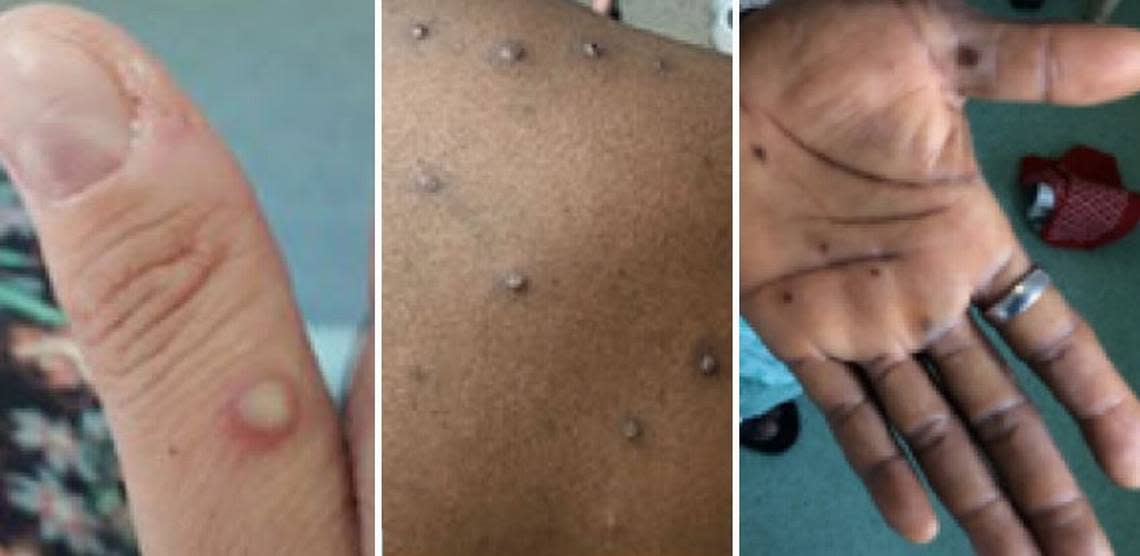 Photos show examples of what the monkeypox rash or lesions can look like on an infected person.
