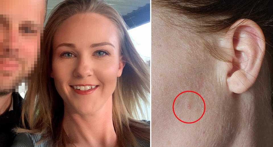 Kate Bourke squamous cell carcinoma skin cancer on face. 