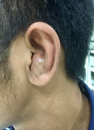 柔道耳是什麼 醫 耳廓假性囊腫