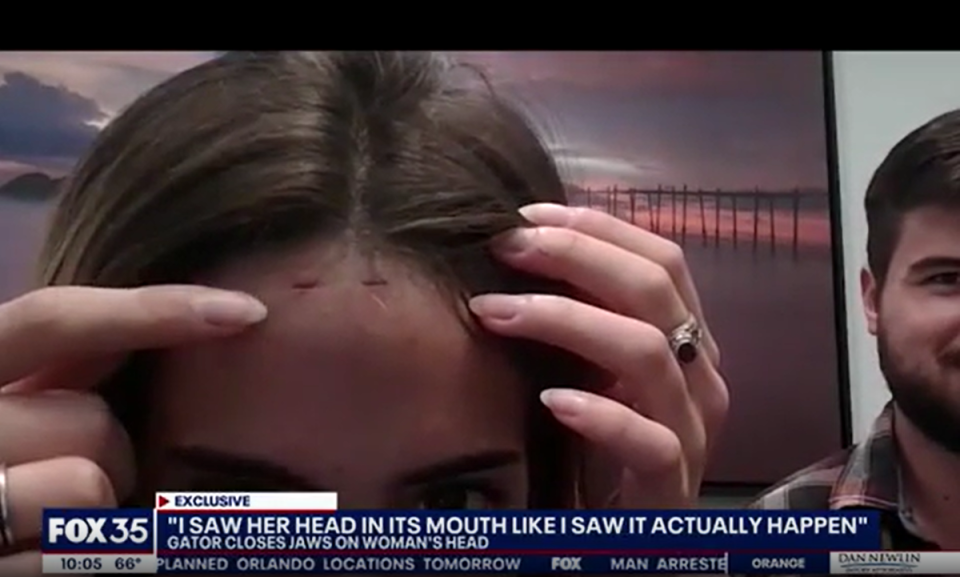 She sustained bite marks on her head as well as on her neck (Fox 35)