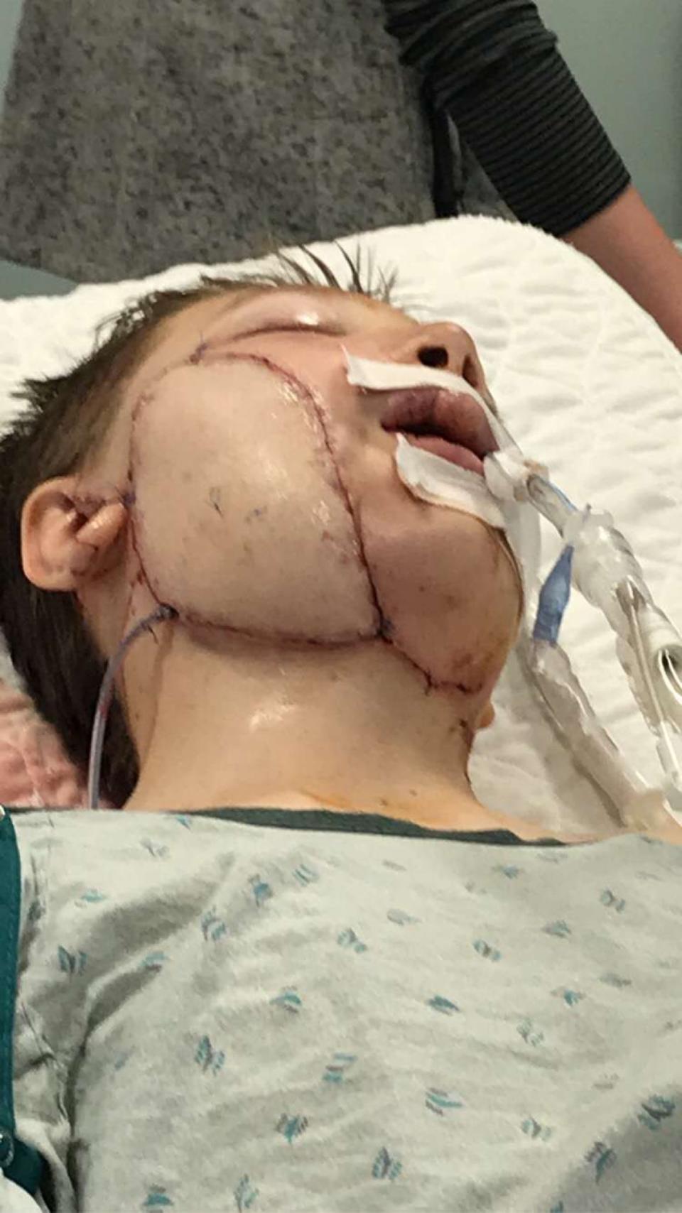 Noah had skin grafted from his thigh onto his face. Source: Media Drum World/Australscope