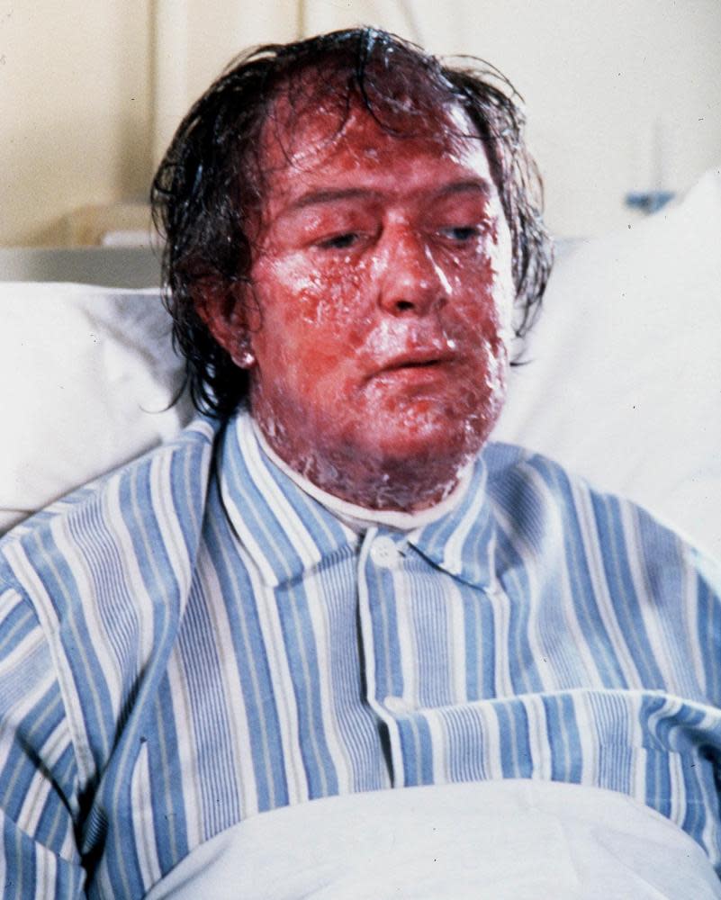 Michael Gambon in hospital bed with skin condition all over face