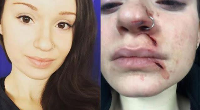 Miss Morris was 'slashed' in the face by a random attacker.