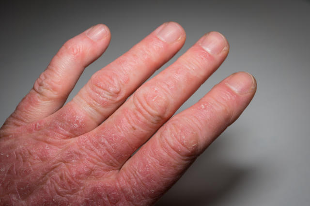 flexible auditoría mucho La artritis que se esconde tras unos dedos inflamados