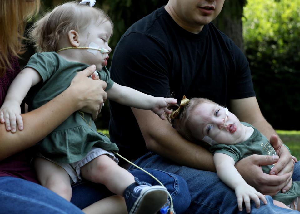 Amelia Irwin reaches out to her twin sister Sarabeth Irwin. Alyson and Phil Irwin with their three kids, Kennedy Irwin, 3 and twins Sarabeth and Amelia Irwin,15-months-old at their Petersburg, Michigan home on Saturday, September 12, 2020. The twins were born conjoined at the chest in 2019. They shared a liver but were each born with two arms, two legs, separate hearts and digestive tracts.  On August 5th of this year and during an 11-hour surgery at C.S. Mott ChildrenÕs Hospital in Ann Arbor, their liver was divided, their chest reconstructed and each had belly buttons made.