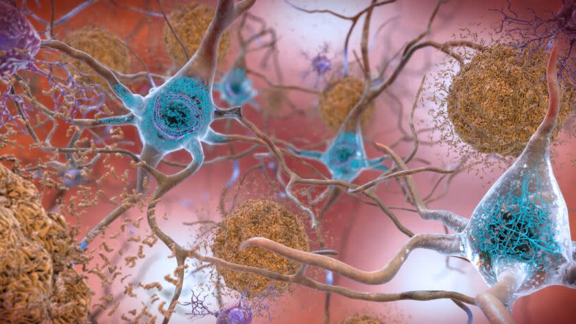 This illustration made available by the National Institute on Aging/National Institutes of Health depicts cells in an Alzheimer's affected brain, with abnormal levels of the beta-amyloid protein clumping together to form plaques, brown, that collect between neurons and disrupt cell function. Abnormal collections of the tau protein accumulate and form tangles, blue, within neurons, harming synaptic communication between nerve cells. An experimental Alzheimer's drug modestly slowed the brain disease's inevitable worsening, researchers reported Tuesday, Nov. 29, 2022 - and the next question is how much difference that might make in people's lives. Japanese drugmaker Eisai and its U.S. partner Biogen had announced earlier this fall that the drug lecanemab appeared to work, a badly needed bright spot after repeated disappointments in the quest for better Alzheimer's treatments. (National Institute on Aging, NIH via AP)