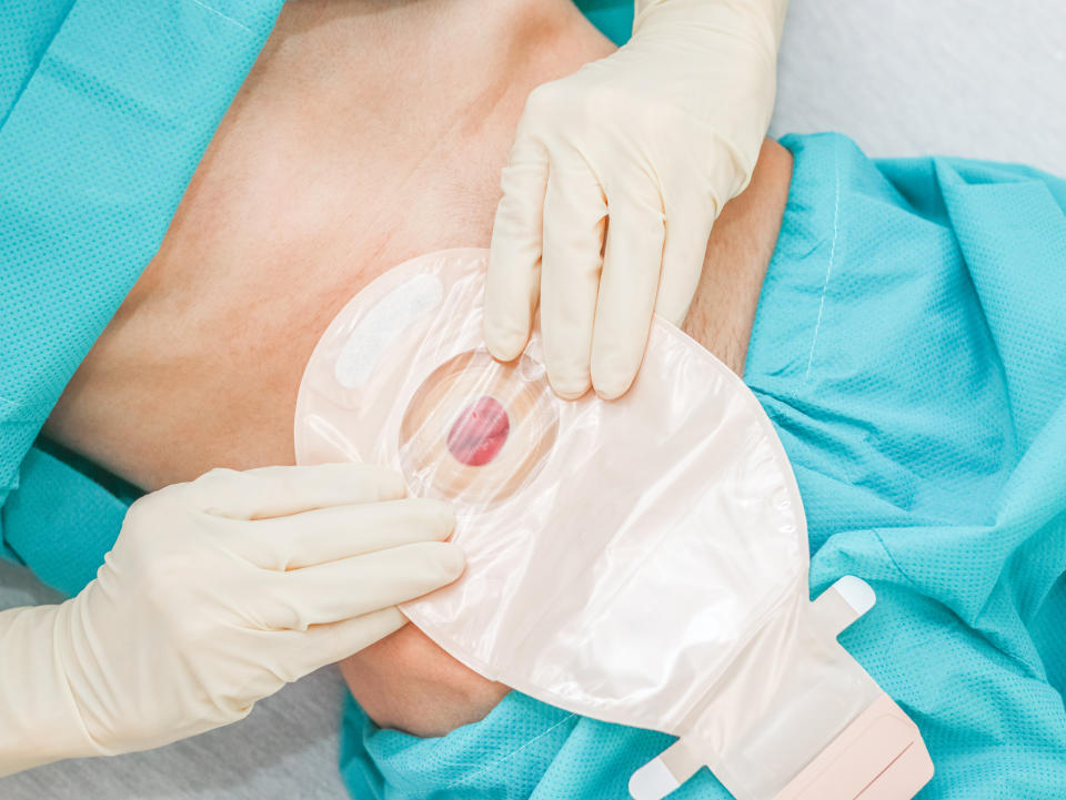 What is a stoma? (Getty Images)