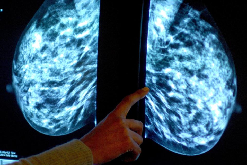 A breast cancer treatment has been given a new licence to help prevent cases among women at risk of the disease (PA Wire)