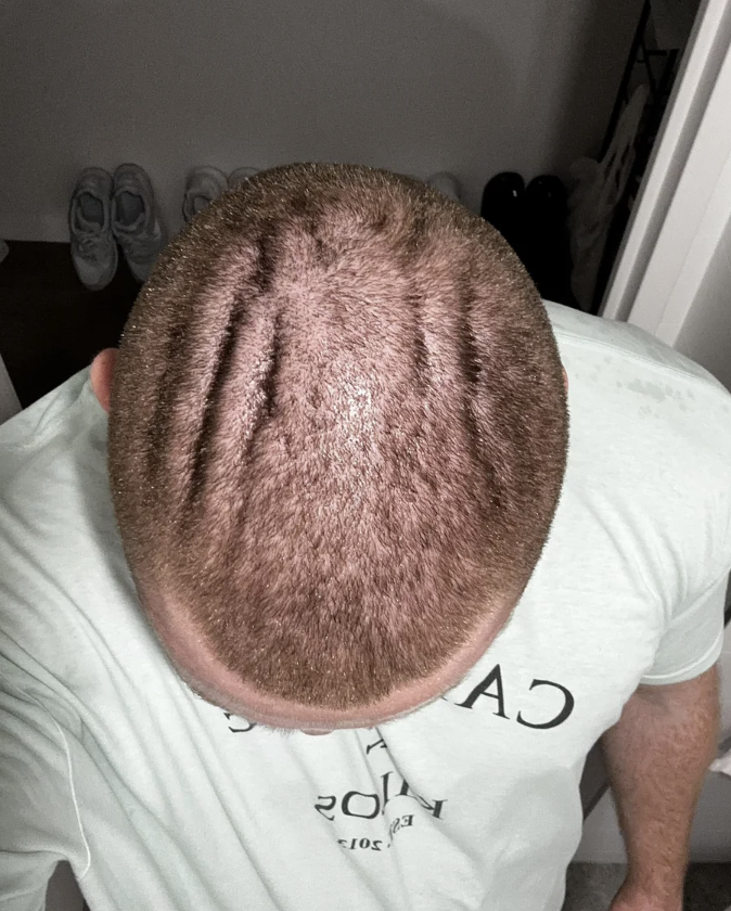 Person with a buzz-cut hairstyle viewed from above, showing unique scalp lines