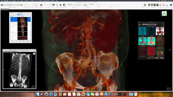 Imagery from a CT scan, rendered as a manipulatable 3D image in OsiriX.