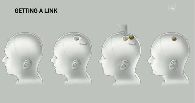 Neuralink implantation