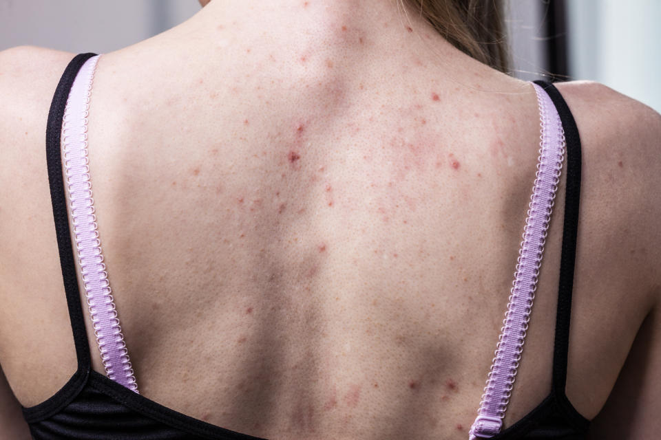 L'acné dans le dos affecte les adultes, souvent en raison de déséquilibres hormonaux, du stress, ou de certains médicaments. (Getty Images/iStockphoto)