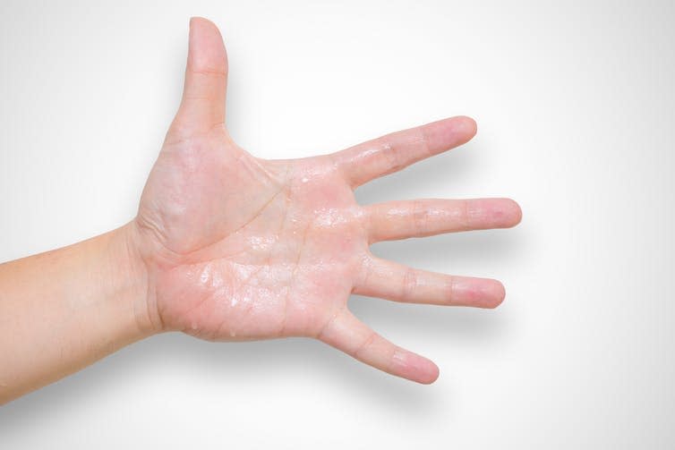 <span class="caption">Hyperhidrosis: a nightmare in business.</span> <span class="attribution"><a class="link " href="https://www.shutterstock.com/image-photo/hyperhidrosis-wet-hand-sweat-syndrome-695565307?src=nwfeUFec8kiGYeTSdnthGg-1-0" rel="nofollow noopener" target="_blank" data-ylk="slk:Quality Stock Arts/Shutterstock.com;elm:context_link;itc:0;sec:content-canvas">Quality Stock Arts/Shutterstock.com</a></span>