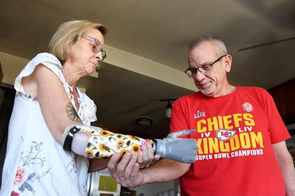 Maggie Munoz tries on a prosthetic arm with the help of her husband, Jeff Walters. She needs a kidney transplant. He plans to be the donor.