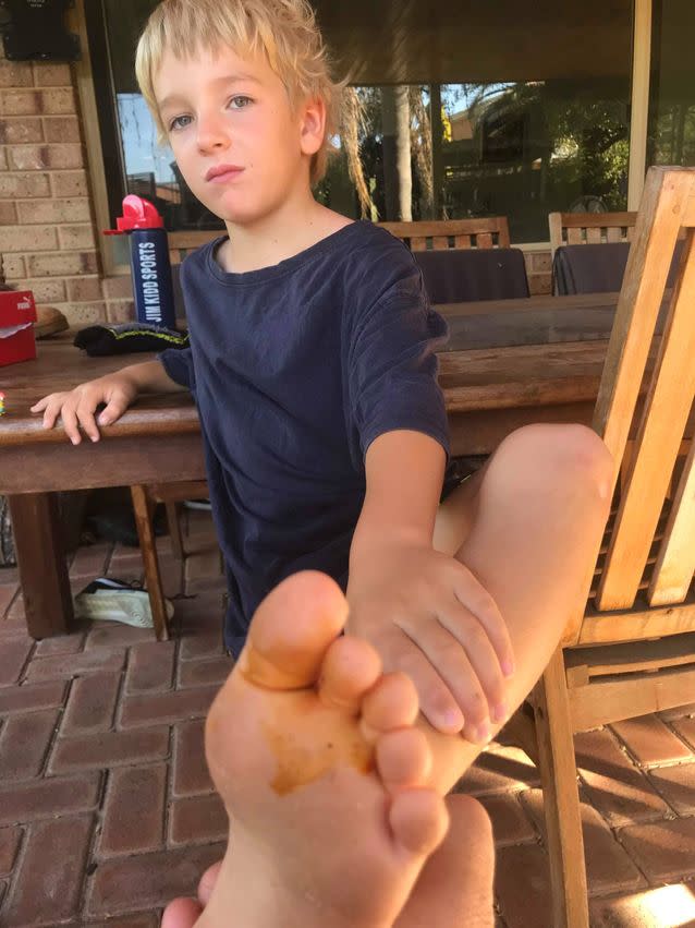 The young boy had felt a pain in his foot and when he reached down to see what it was, his finger became hooked as well. Source: Supplied