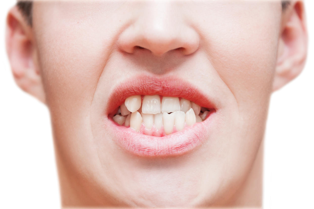 Young man showing crooked growing teeth. The man needs to go to the dentist to install braces.