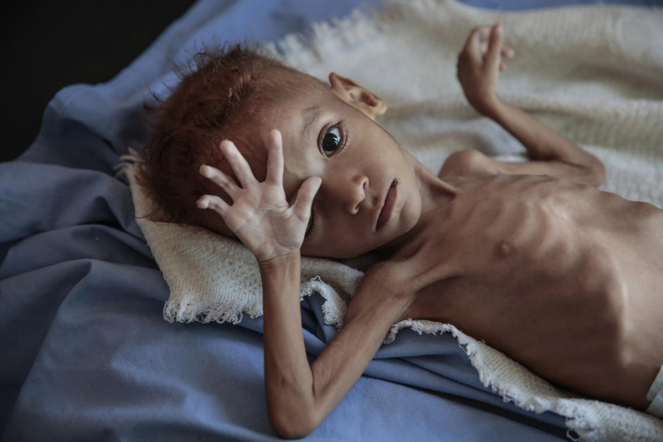 FILE - In this Oct. 1, 2018, file, photo, a severely malnourished boy rests on a hospital bed at the Aslam Health Center, Hajjah, Yemen. An estimated 85,000 children under age 5 may have died of hunger and disease since the outbreak of Yemen’s civil war in 2015, an international aid group said Wednesday, Nov. 21, 2018. (AP Photo/Hani Mohammed, File)