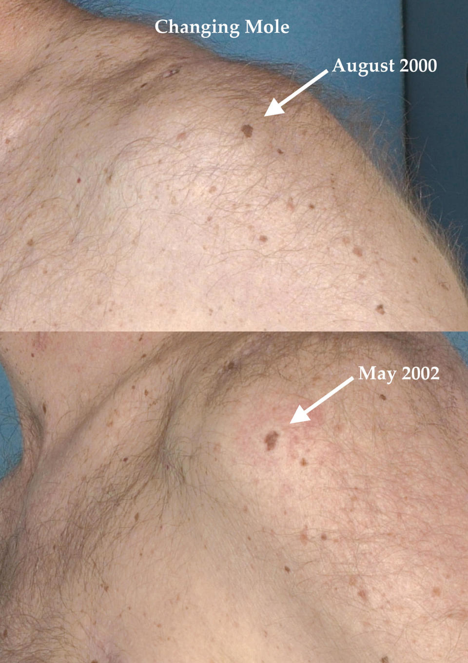 A melanoma that illustrates how cancerous moles may evolve in shape and size over time. (Courtesy The Skin Cancer Foundation)