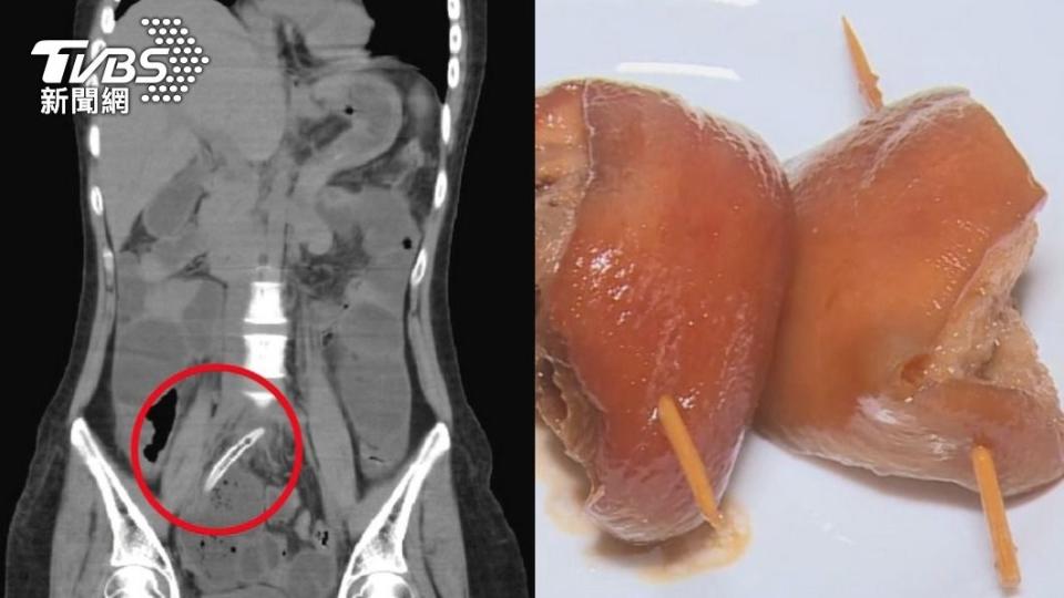 台中女子疑狼吞爌肉，竟吃進4公分。（圖／TVBS）