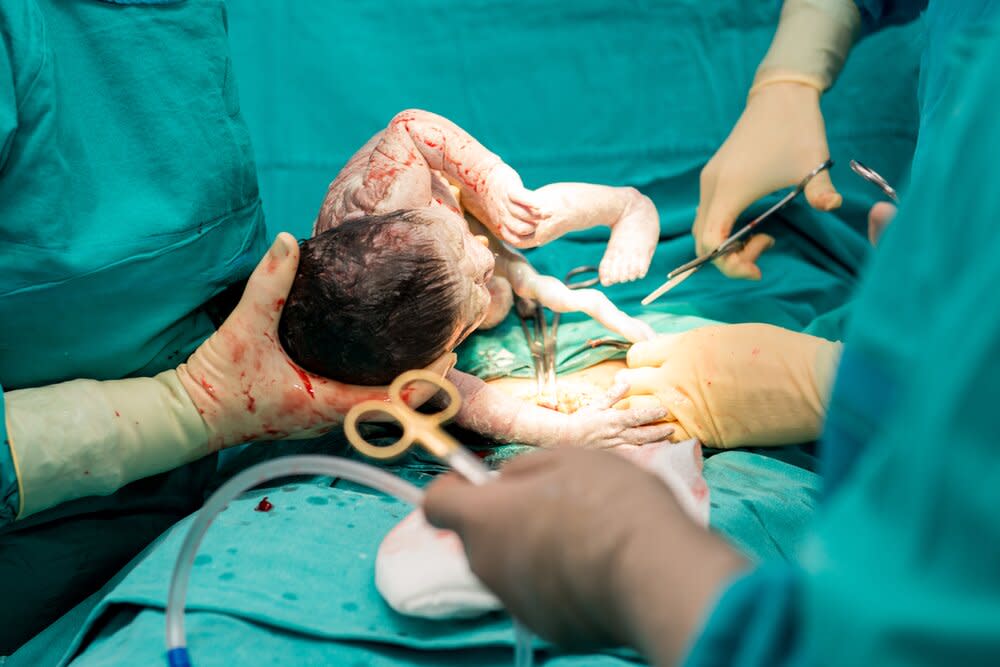 baby born via cesarean section