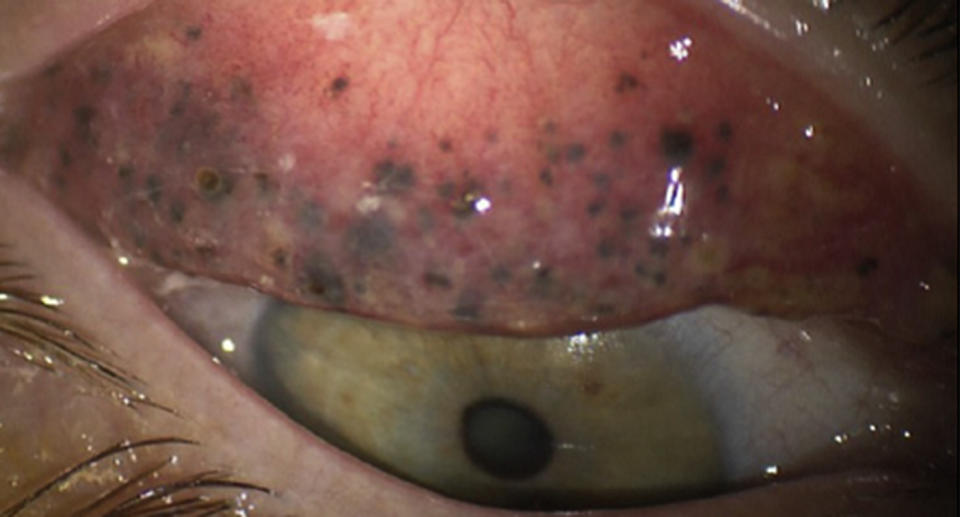 The 50-year-old woman had no idea what was causing the horrific infection. Source: American Academy of Ophthalmology