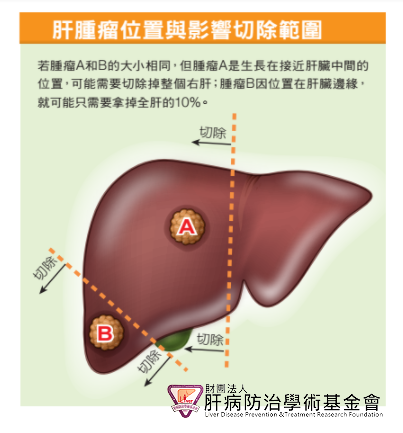 若腫瘤A和B的大小相同,但腫瘤A是生長在接近肝臟中間的位置,可能需要切除掉整個右肝;腫瘤B因位置在肝臟邊緣,就可能只需要拿掉全肝的10%。