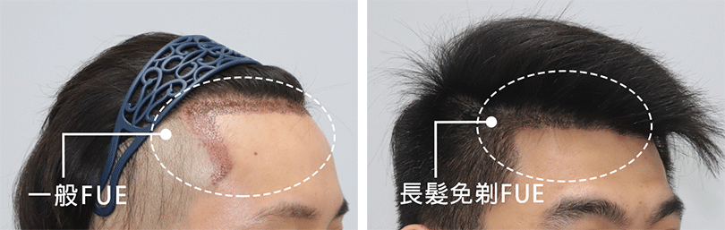圖六：一般FUE與長髮免剃FUE手術隔日差異