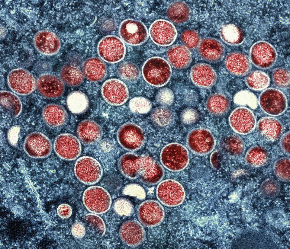 FILE - This image provided by the National Institute of Allergy and Infectious Diseases (NIAID) shows a colorized transmission electron micrograph of monkeypox particles (red) found within an infected cell (blue), cultured in the laboratory that was captured and color-enhanced at the NIAID Integrated Research Facility (IRF) in Fort Detrick, Md. On Friday, Aug. 12, 2022, The Associated Press reported on stories circulating online incorrectly claiming that monkeypox hasn't been detected in Georgia drinking water. The July 26 Atlanta-area news broadcast broadcast is being mischaracterized online to push the false claim that monkeypox has been found in residents’ tap water. (NIAID via AP)