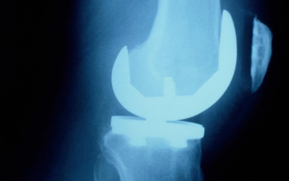 The MHRA is preparing to issue a field safety notice over a faulty knee replacement - Getty Images