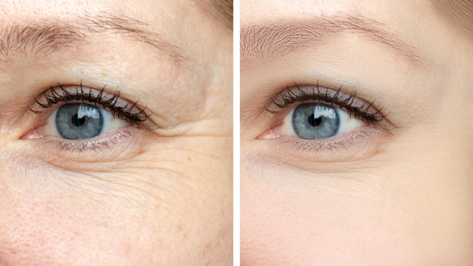 Eye-Wrinkle-Crows-Feet-Before-After-Stock-Photo