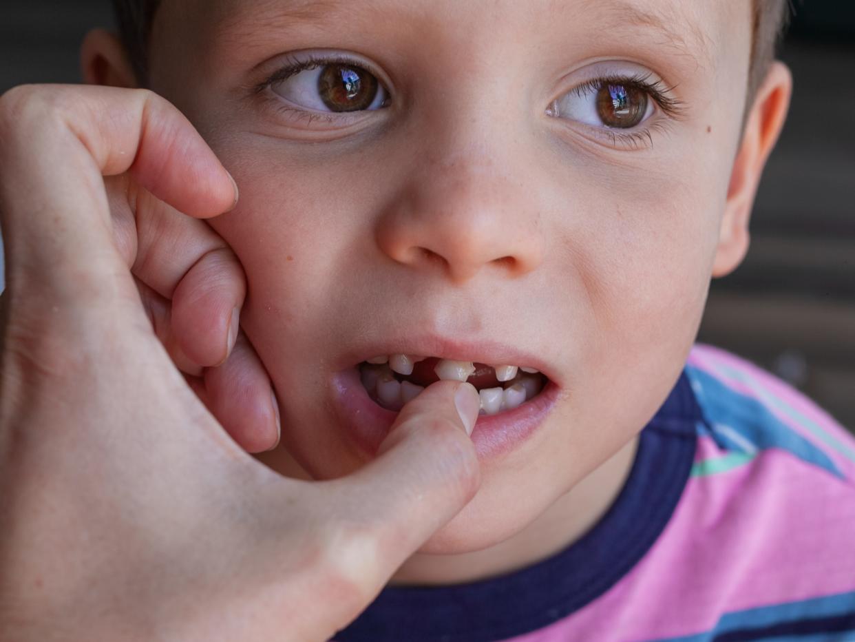 Strong Boy Pulls Out His Own Tooth. Loss Of Healthy Baby Teeth