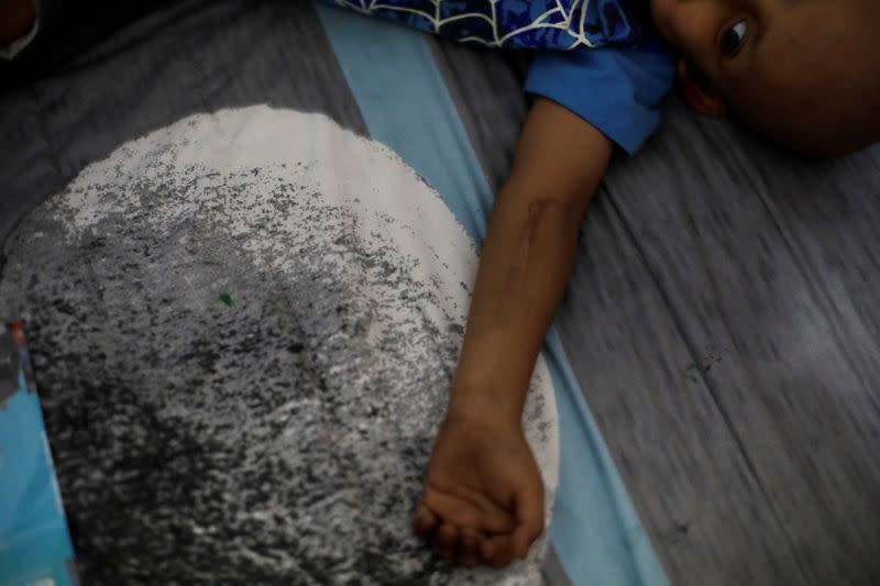 Hermes Soto shows the scar on his left arm at his house in Mexico City