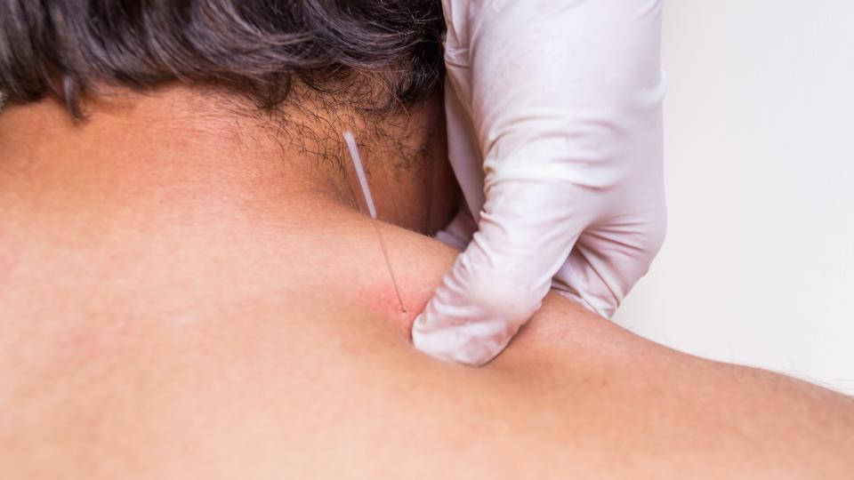 Puncion seca dry needling acupunture fisio