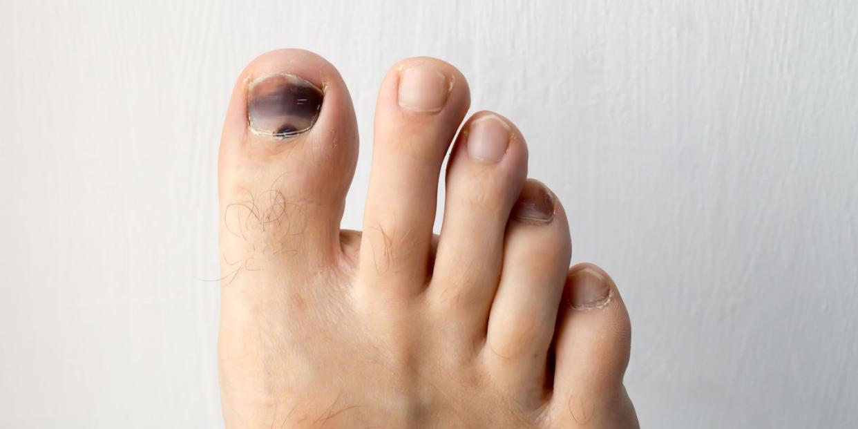 5 Reasons Youre Dealing With A Black Toenail According To A Dermatologist